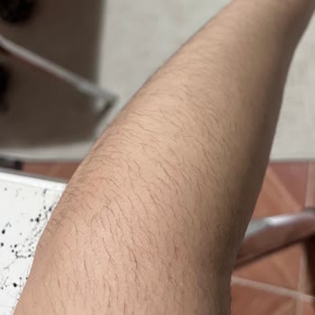 Lazer Epilasyon Sonrası Hiçbir Fayda Görmedim, Klinik Sorumluluk Almadı