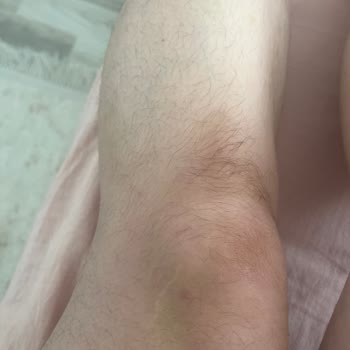 Lazer Epilasyon Sonrası Hiçbir Fayda Görmedim, Klinik Sorumluluk Almadı