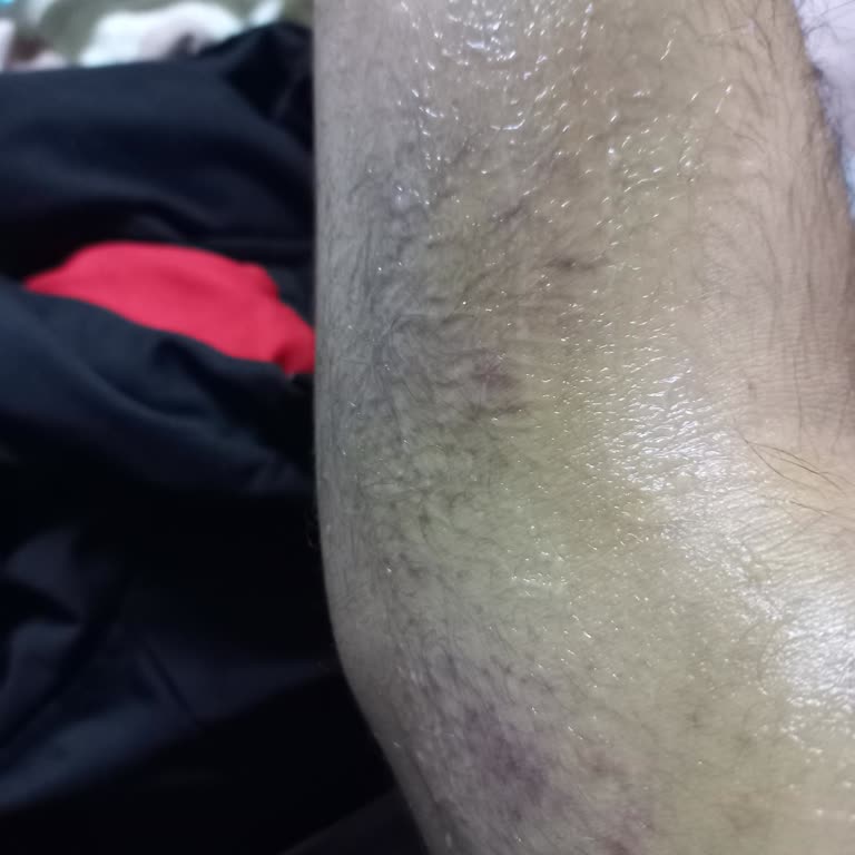 Türk Kızılay Kan Bağışı Sonrası Artan Morarma Ve Ağrı Endişesi