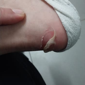 Kısa Süreli Kullanımda Yaralanmaya Sebep Olan Ayakkabı Ve İade Sorunu