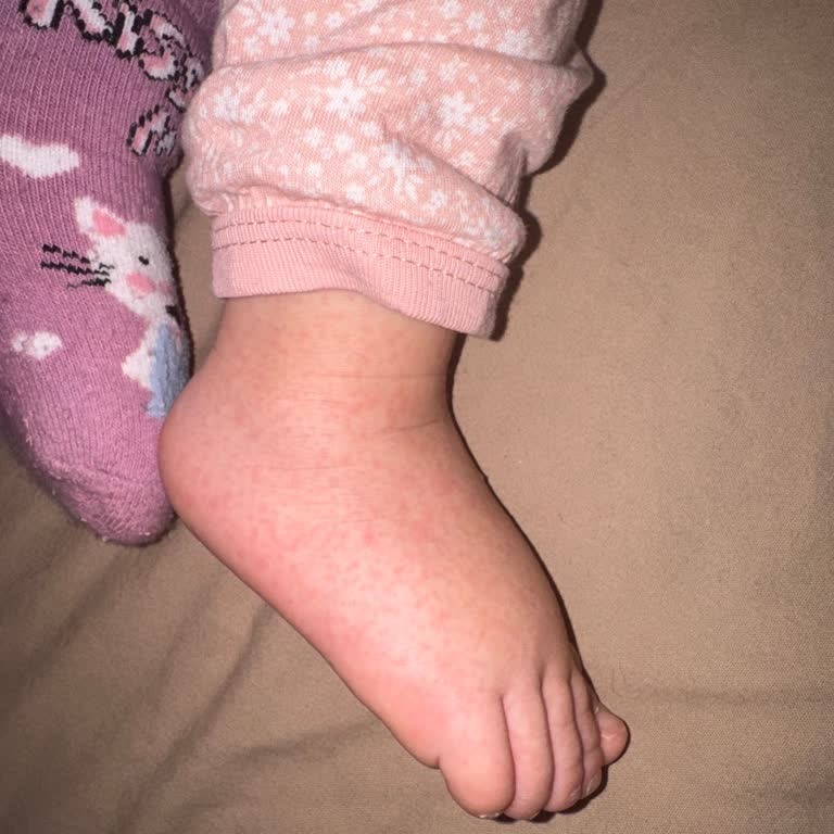 Molfix 6 Numara Bebek Bezi Kızımda Ciddi Alerjik Reaksiyonlara Yol Açtı