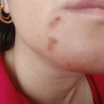 Faturasız Ve Onaysız Ürün: Benson Cildimi Mahvetti!