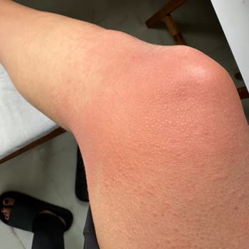 Vitafenix Aktif B Kompleks Tablet Sonrası Ciddi Alerjik Reaksiyon Ve Yetersiz Müşteri Hizmeti