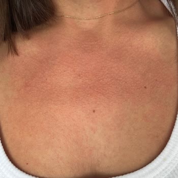 Vitafenix Aktif B Kompleks Tablet Sonrası Ciddi Alerjik Reaksiyon Ve Yetersiz Müşteri Hizmeti