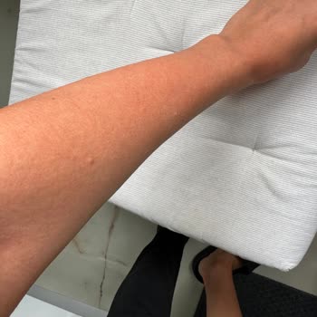 Vitafenix Aktif B Kompleks Tablet Sonrası Ciddi Alerjik Reaksiyon Ve Yetersiz Müşteri Hizmeti