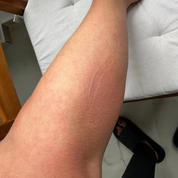 Vitafenix Aktif B Kompleks Tablet Sonrası Ciddi Alerjik Reaksiyon Ve Yetersiz Müşteri Hizmeti