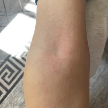 Mustela Vücut Losyonu Oğlumda Ciddi Alerjik Reaksiyona Yol Açtı, Çözüm Alamadım