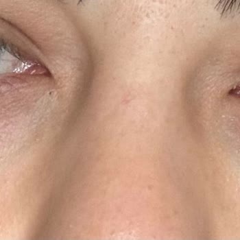 Göz Altı Dolgusu Sonrası Kalıcı Hasar Ve Klinik İlgisizliği