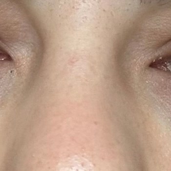 Göz Altı Dolgusu Sonrası Kalıcı Hasar Ve Klinik İlgisizliği