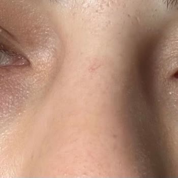 Göz Altı Dolgusu Sonrası Kalıcı Hasar Ve Klinik İlgisizliği