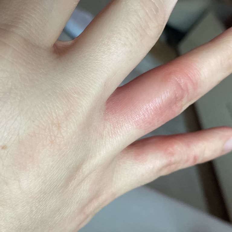 Stanley Termosun Kapağı Patladı Elim Yandı