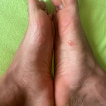 Uzun Koşuda Yara Yapan Ayakkabıya Çözüm Sunulmadı, Değişim Talebim Reddedildi