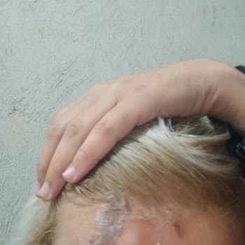 Saç Boyası Yüzümü Yaktı, Acil Dönüş Bekliyorum