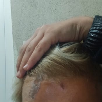 Saç Boyası Yüzümü Yaktı, Acil Dönüş Bekliyorum