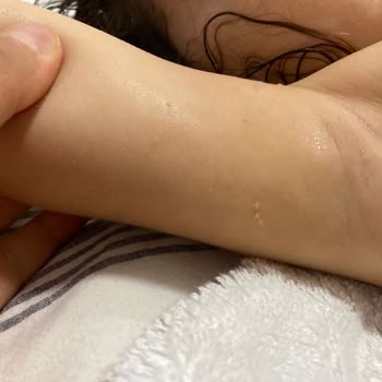 Mustela Pişik Kremi Ciltte Kabarcık Ve Kızarıklık Yaptı