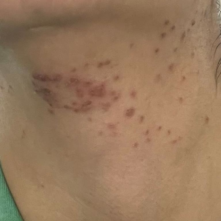 Tanya Güzellik ve Yaşam Merkezi Yüzümde Derin Yanıklar Oluştu