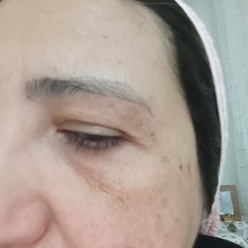 Slim Tone İşlemi Sonrası Sağlık Sorunu Ve İlgisiz Tavırlarla Karşılaştım