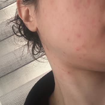 Kozmetik Ürün Kullanımı Sonrası Ciddi Alerjik Reaksiyon Ve İade Talebi