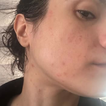 Kozmetik Ürün Kullanımı Sonrası Ciddi Alerjik Reaksiyon Ve İade Talebi