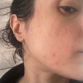 Kozmetik Ürün Kullanımı Sonrası Ciddi Alerjik Reaksiyon Ve İade Talebi