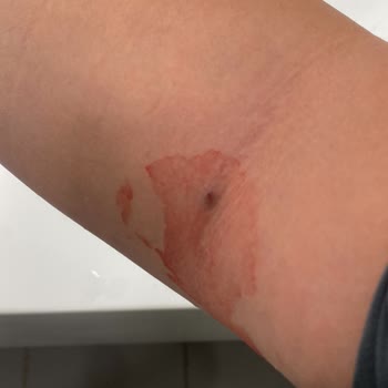 Manisa Şehir Hastanesi Kan Alma İşleminde Üstüm Başım Kan Oldu Ve Kolumda Morarma Meydana Geldi!