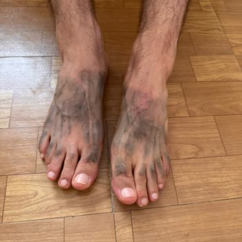 Birkenstock Terlik Ayağımı Yaraladı, İade Talebim Reddedildi