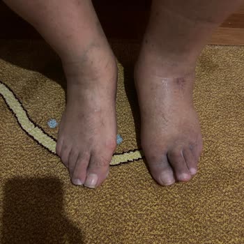 Ameliyat Sonrası Komplikasyonlar Ve Tekrarlayan Ücret Talepleriyle Mağduriyet Yaşadım