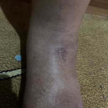 Ameliyat Sonrası Komplikasyonlar Ve Tekrarlayan Ücret Talepleriyle Mağduriyet Yaşadım