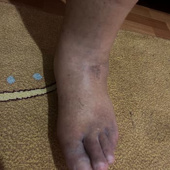 Ameliyat Sonrası Komplikasyonlar Ve Tekrarlayan Ücret Talepleriyle Mağduriyet Yaşadım