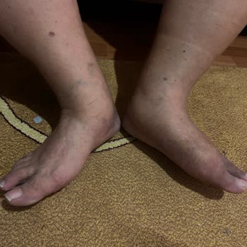 Ameliyat Sonrası Komplikasyonlar Ve Tekrarlayan Ücret Talepleriyle Mağduriyet Yaşadım