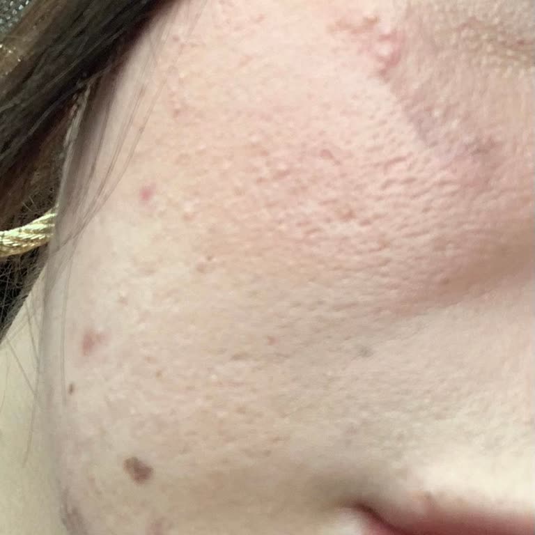 Clinique Sivilce Seti Yüzümde Yanık Ve Tahrişe Sebep Oldu, Çözüm Sunulmadı