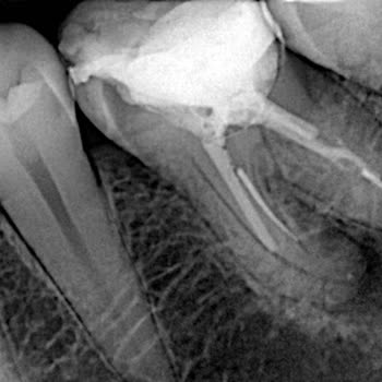 Kanal Tedavisinde İğne Kırığı Mağduriyeti Ve Yetersiz Çözüm