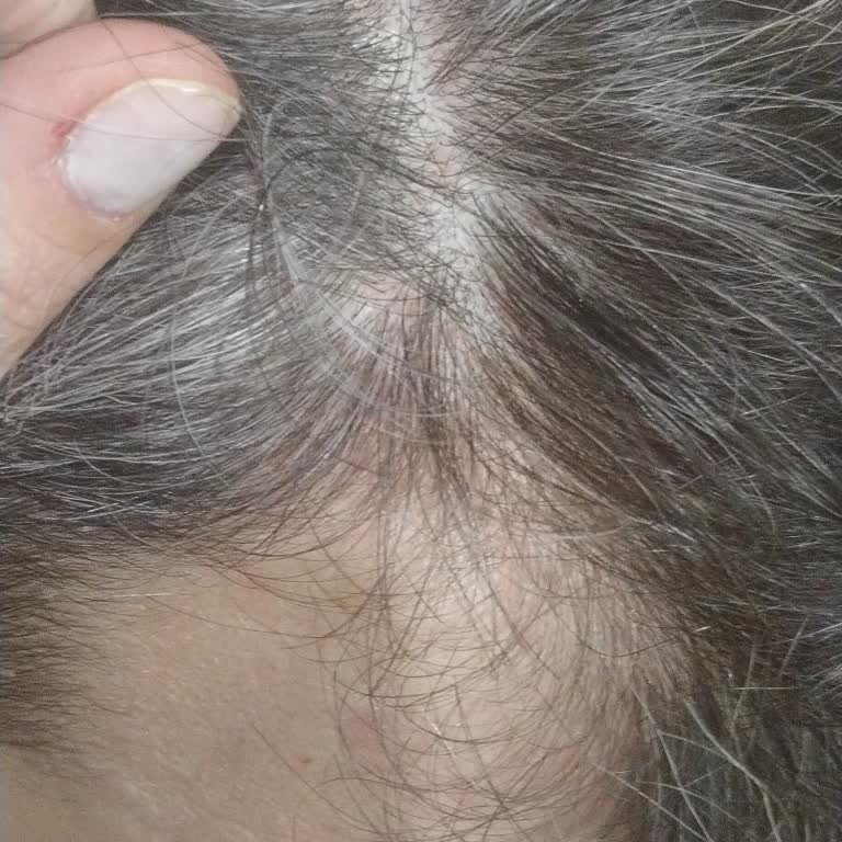 Şampuan Saç Dökülmesini Ve Kaşıntıyı Artırdı