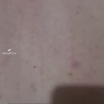 Veet Tüy Dökücü Krem Alerji Yaptı!