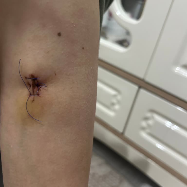 Lazer Epilasyon Sonrası Kolumdaki Benin Zarar Görmesiyle Başlayan Kabus