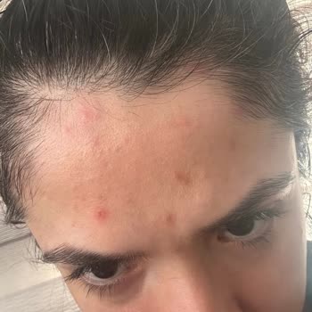 Alerjik Reaksiyon Sonrası Ücret İadesi Talebi Ve Müşteri Hizmetlerine Ulaşamama