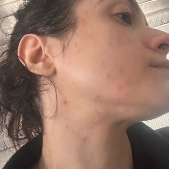 Alerjik Reaksiyon Sonrası Ücret İadesi Talebi Ve Müşteri Hizmetlerine Ulaşamama