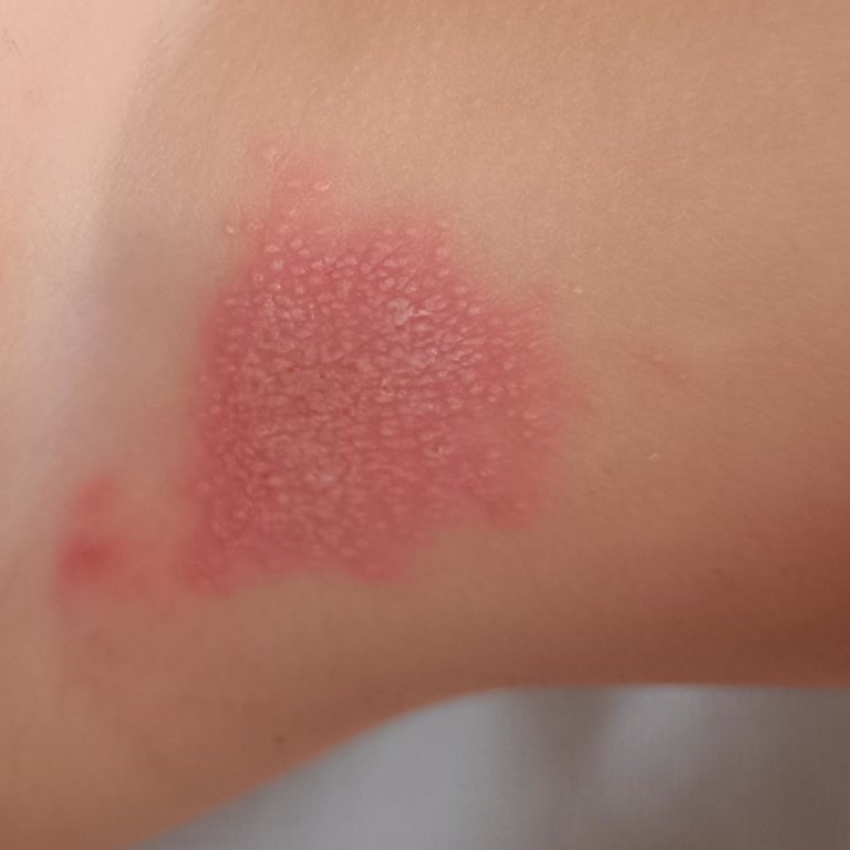 Sleepy Natural 5 Junior Bezde Sızdırma Ve Cilt Sorunları Yaşadım