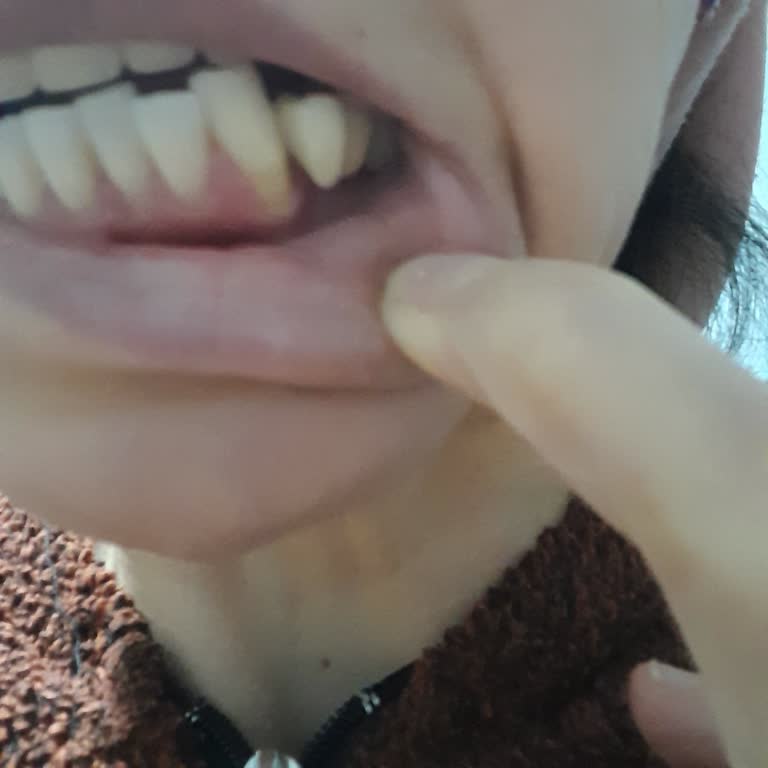 Yanlış İmplant Sonrası Kemik Kaybı Ve İlgisiz Klinik Yaklaşımı