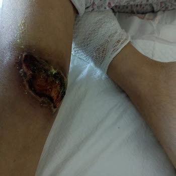 Yoğun Bakımda Anneme Kötü Muamele Ve Yatak Yaralarıyla İlgili Şikayetimiz Dikkate Alınmadı