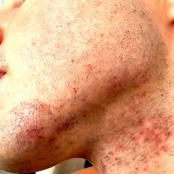 Tıraş Makinesi Tahriş Sorunu Ve Ücret İadesi Talebim Karşılanmadı