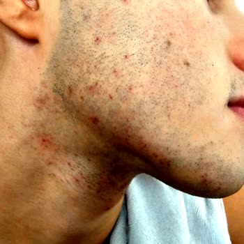 Tıraş Makinesi Tahriş Sorunu Ve Ücret İadesi Talebim Karşılanmadı