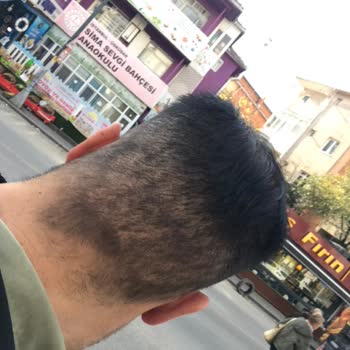 Saç Ekimi Sonrası Kötü Görüntü Ve Kalıcı Sorun