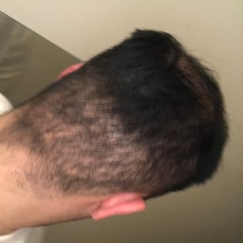 Saç Ekimi Sonrası Kötü Görüntü Ve Kalıcı Sorun