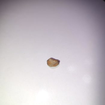 Kuruyemişten Çıkan Taş Dişimi Kırıyordu Çocuklar İçin Tehlikeli