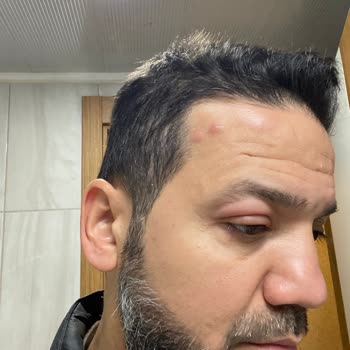 Otel Odasında Tahta Kurusu Isırığı Ve Yetersiz Yönetim İlgisi