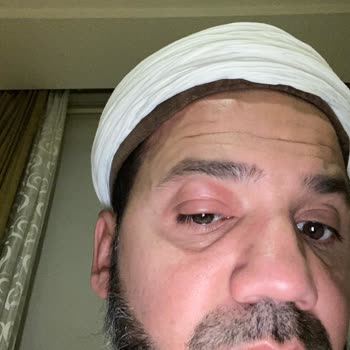 Otel Odasında Tahta Kurusu Isırığı Ve Yetersiz Yönetim İlgisi