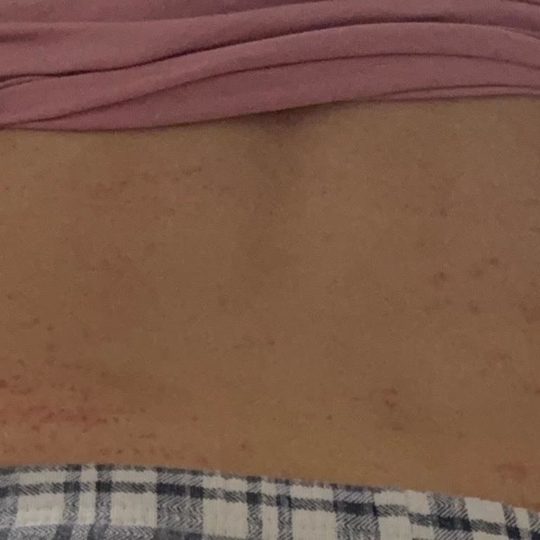 Lazer Epilasyon Sonrası Belimde İz Ve İlgisizlik