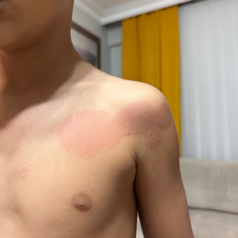 Аллергическая реакция после употребления юиойогурта Активиа Черника