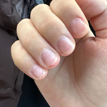 Protez Tırnak Uygulaması Sonrası Ciddi Sağlık Sorunları Ve Memnuniyetsizlik